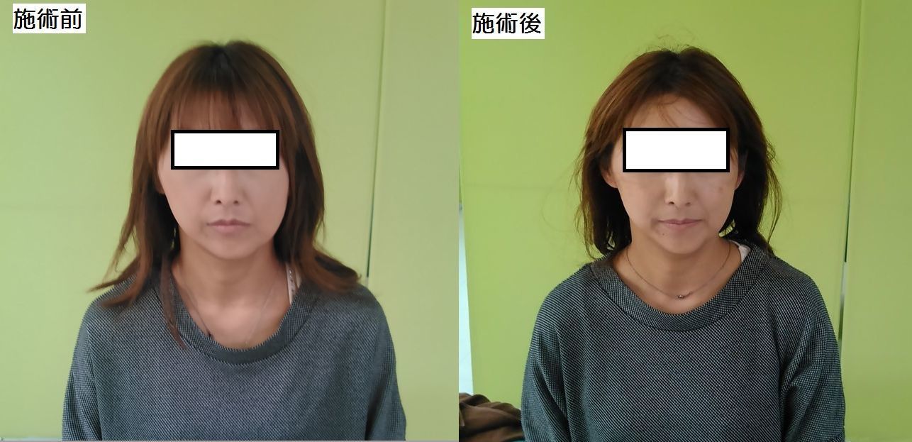 小顔矯正