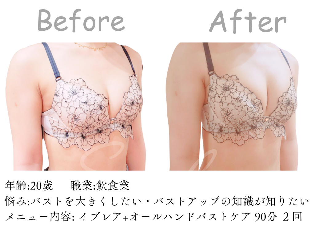 光豊胸 バスト エステ