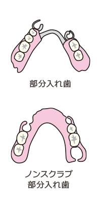 部分入れ歯