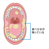 食べかすが残りやすい場所