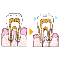 歯周病