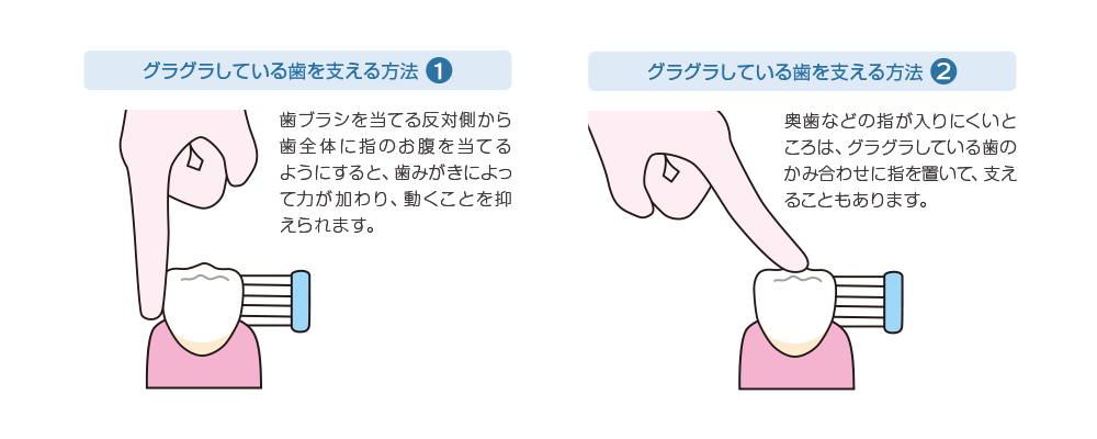 グラグラしている歯のみがき方