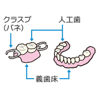入れ歯の種類