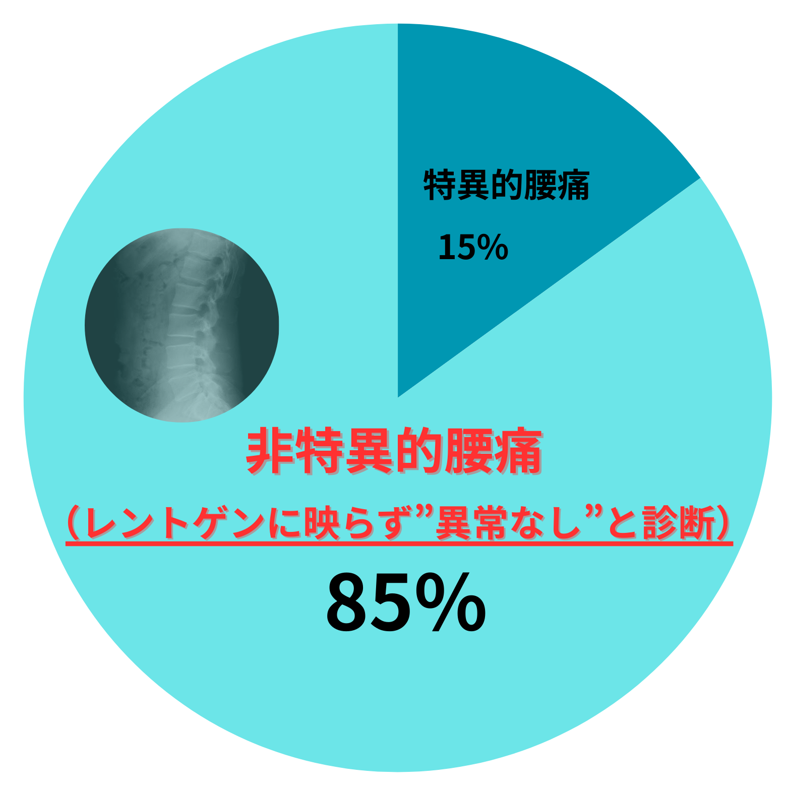 腰痛における、特異性腰痛と非特異性腰痛の割合の図。非特異性腰痛は約80%