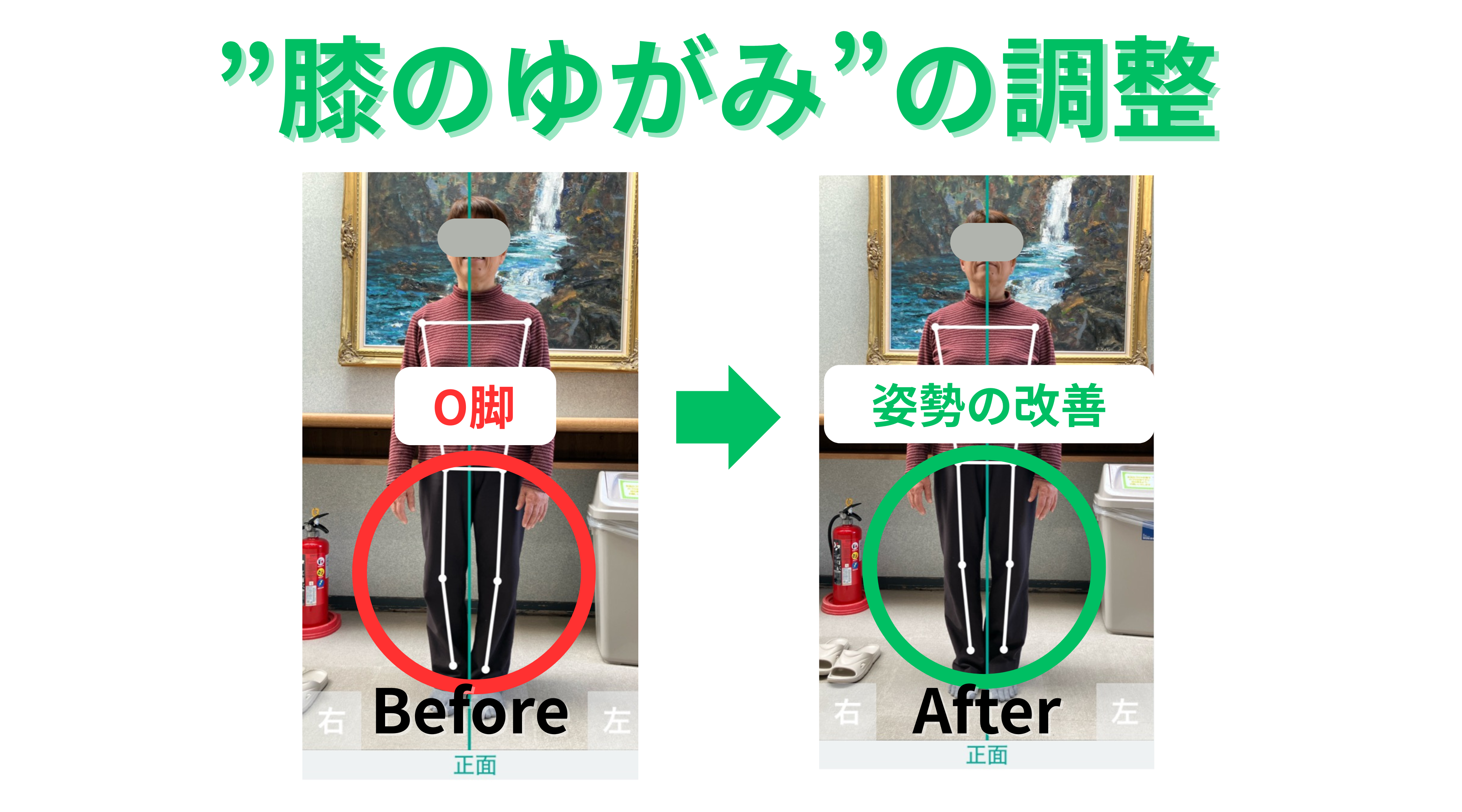 とある女性の体のゆがみが改善された、施術前後の比較写真。O脚が改善。