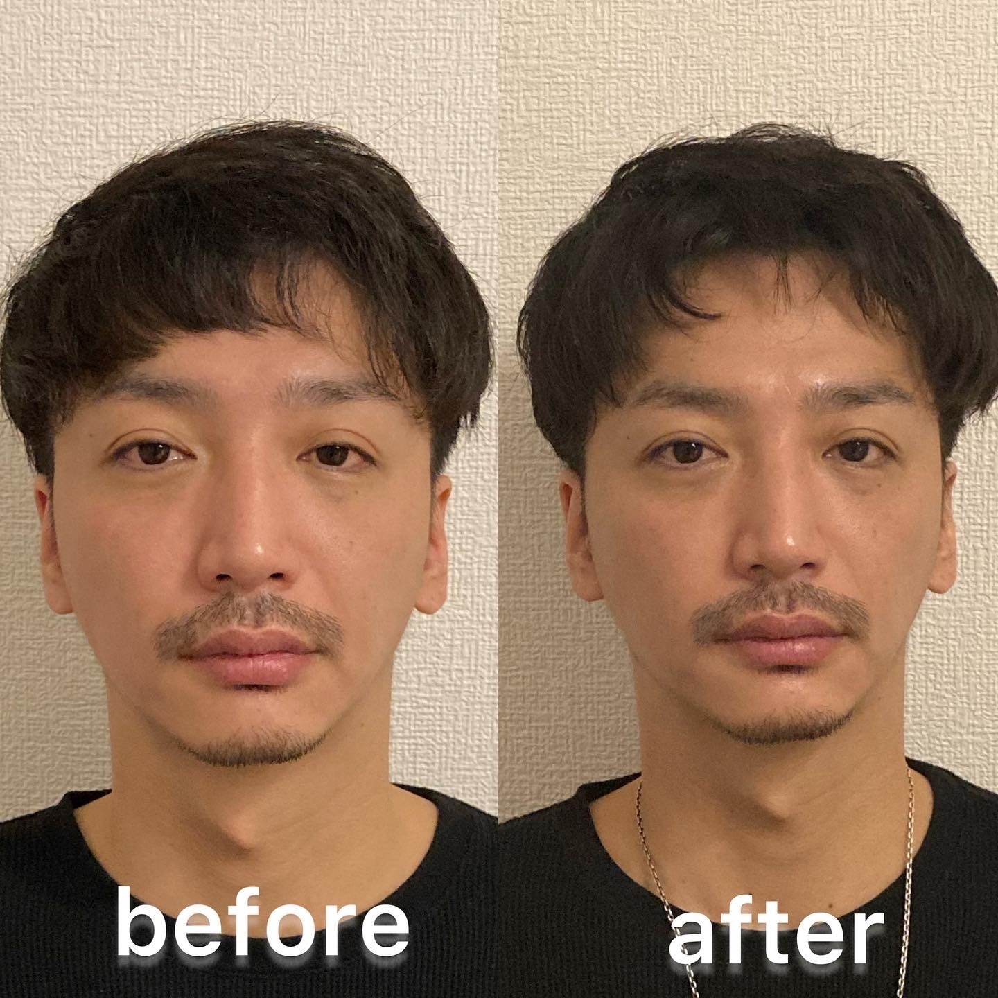 小顔/コルギ/メンズ/ビフォーアフター/むくみ解消/吉祥寺