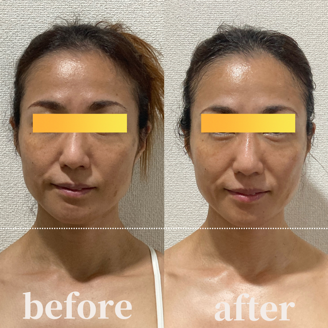 コルギ/小顔/吉祥寺/お客様の声/口コミ/ビフォーアフター