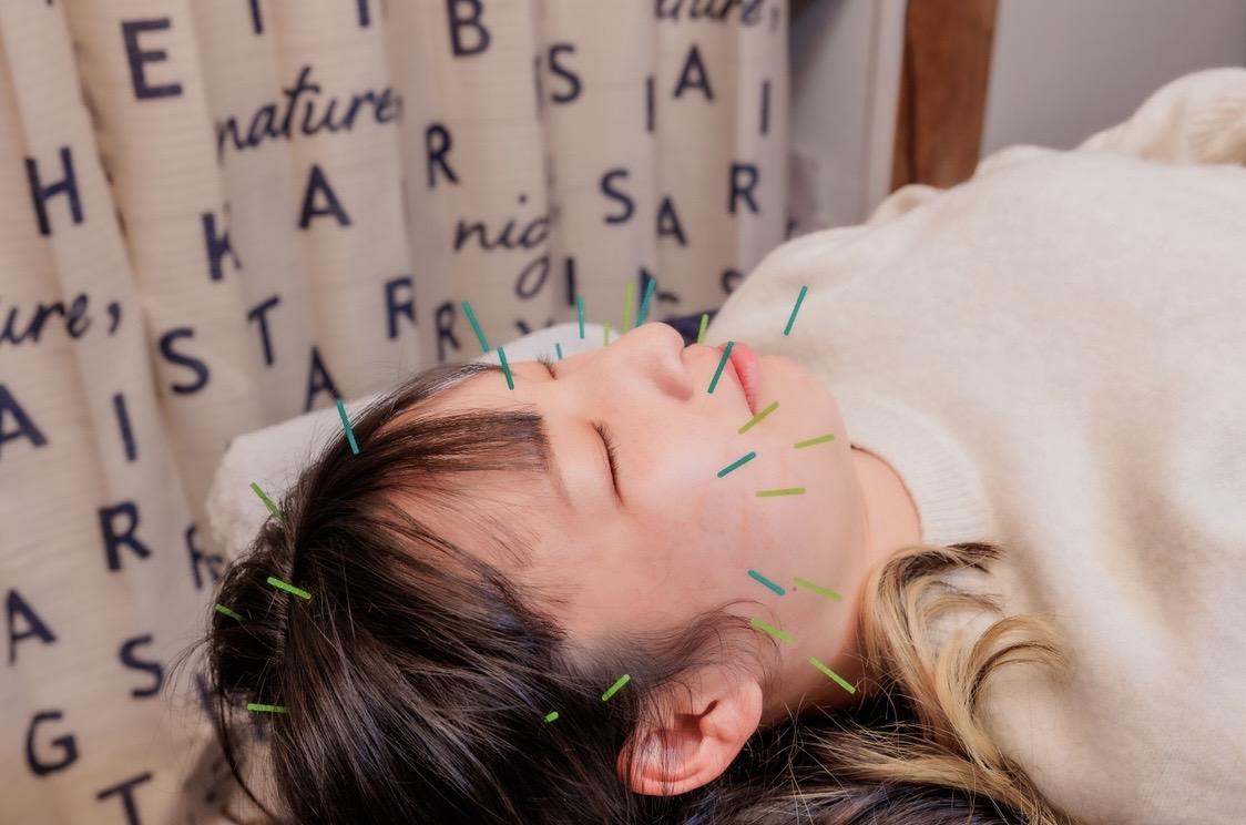 顔の鍼は美容や全身のコンディション調整で