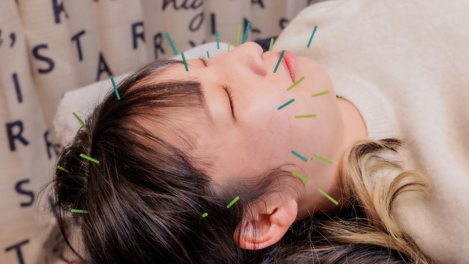 美容や健康面に顔に鍼