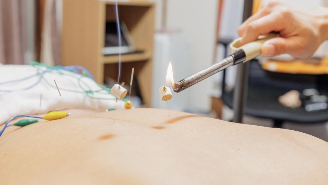 だるい腰は灸頭鍼で温める