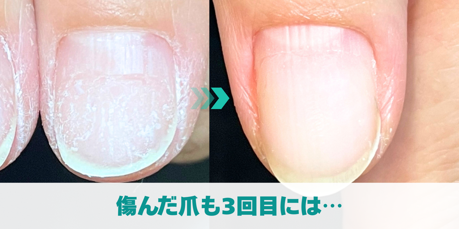 傷んだ爪も3回目には…