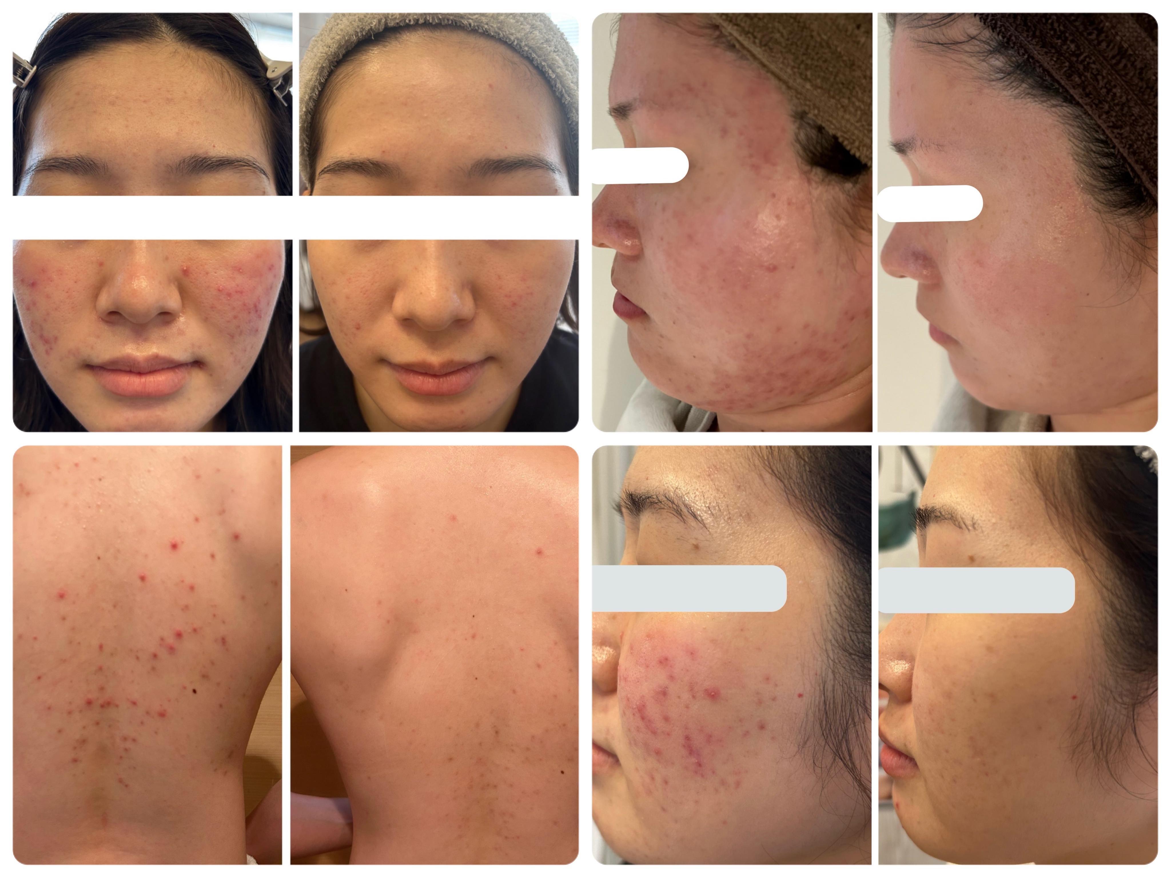 滋賀県草津市の肌改善専門サロン