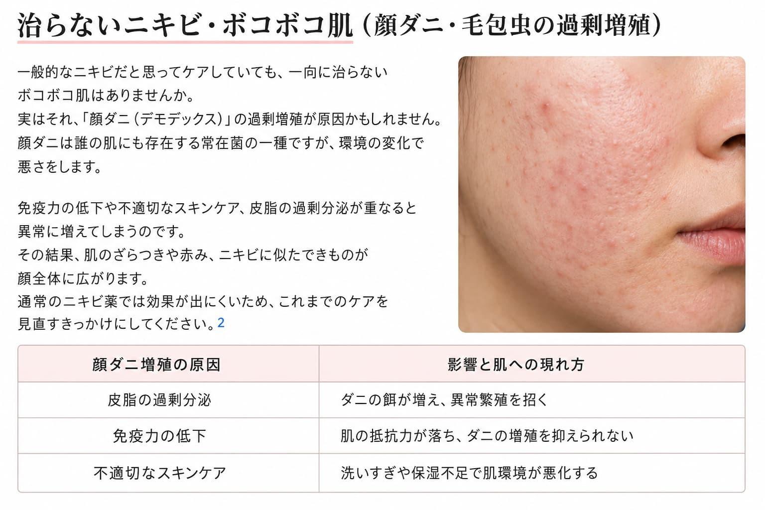 治らないニキビ・ボコボコ肌（顔ダニ・毛包虫の過剰増殖）