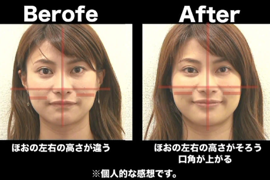 あきる野市で人気メニュー美容鍼小顔矯正の効果が気になる方におすすめのすえきち鍼灸治療院 あきる野市で人気メニュー美容鍼小顔矯正の効果が気になる方におすすめのすえきち鍼灸治療院