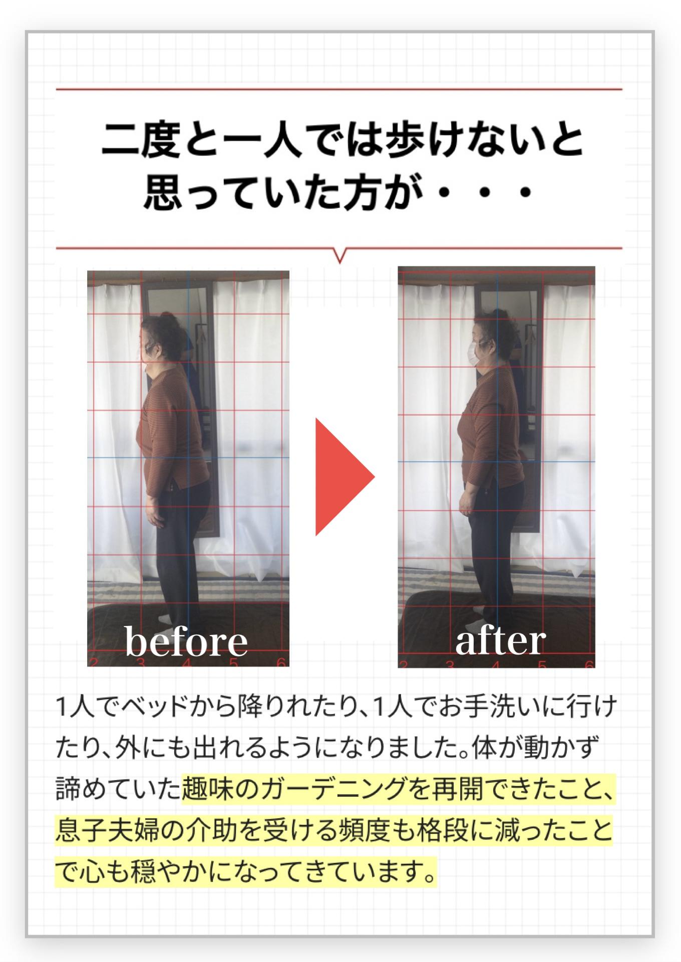 普通の日常生活を送ること すら困難だった方が・・・  before  after  人目を気にするあまり外出も億劫になり家に篭る ことが多かったのですが、歩けるようになったこと で友達とランチに行ったり、雑貨屋さん巡りをした り、やりたい事が普通にできる毎日に幸せを感じています。