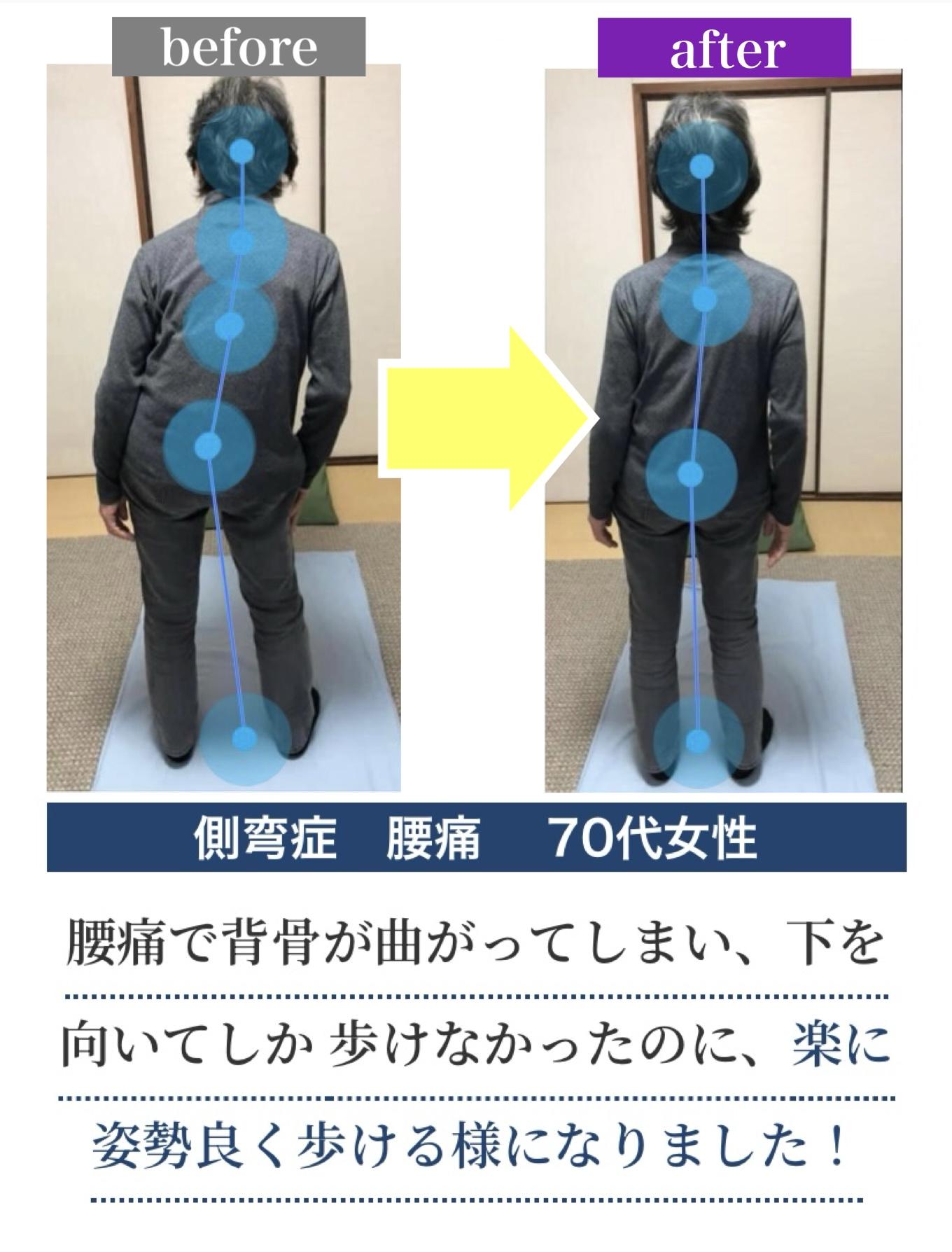 before  after  側彎症 腰痛 80代主婦  杖が無いと背すじを伸ばせないくら  いの強い腰の痛みがたった1回の施術で腰が反れる様になりました