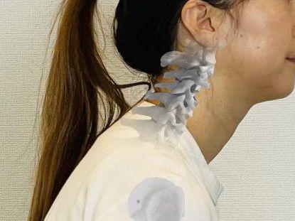 頸椎変形症の写真