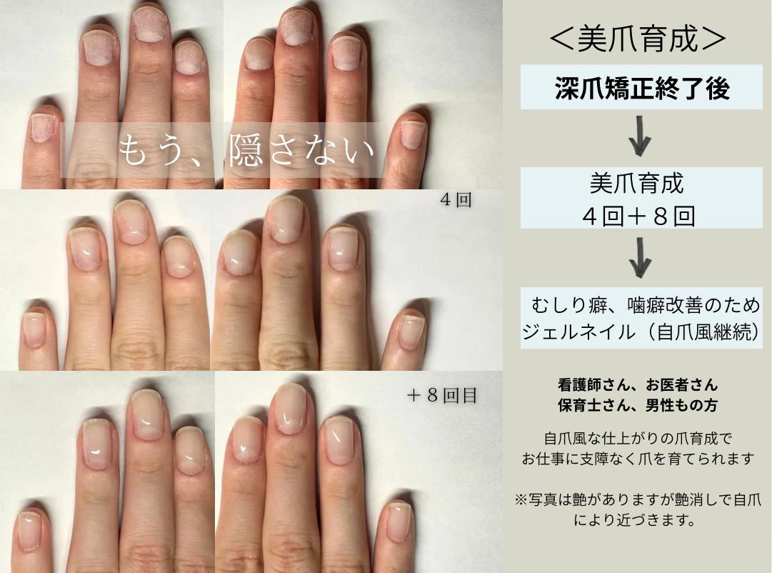 名古屋市深爪矯正専門店ネイルサロンクウ事例写真