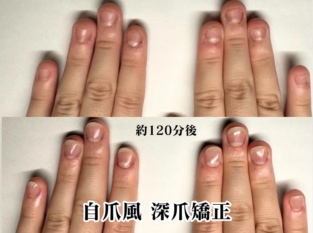 名古屋市深爪矯正専門店ネイルサロンクウ事例写真