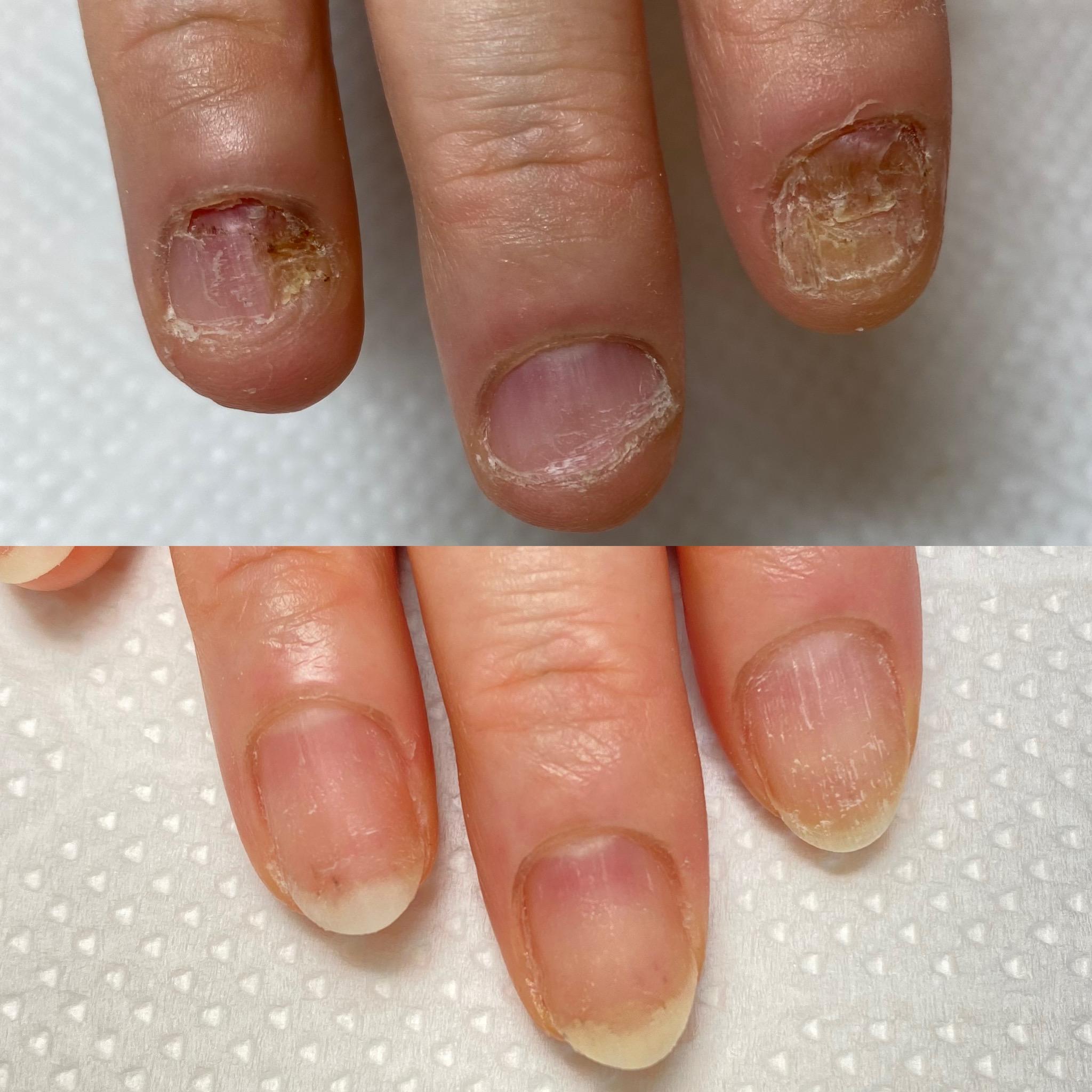 仙台市若林区リプロネイル式深爪矯正専門ネイルサロン デイジー事例写真