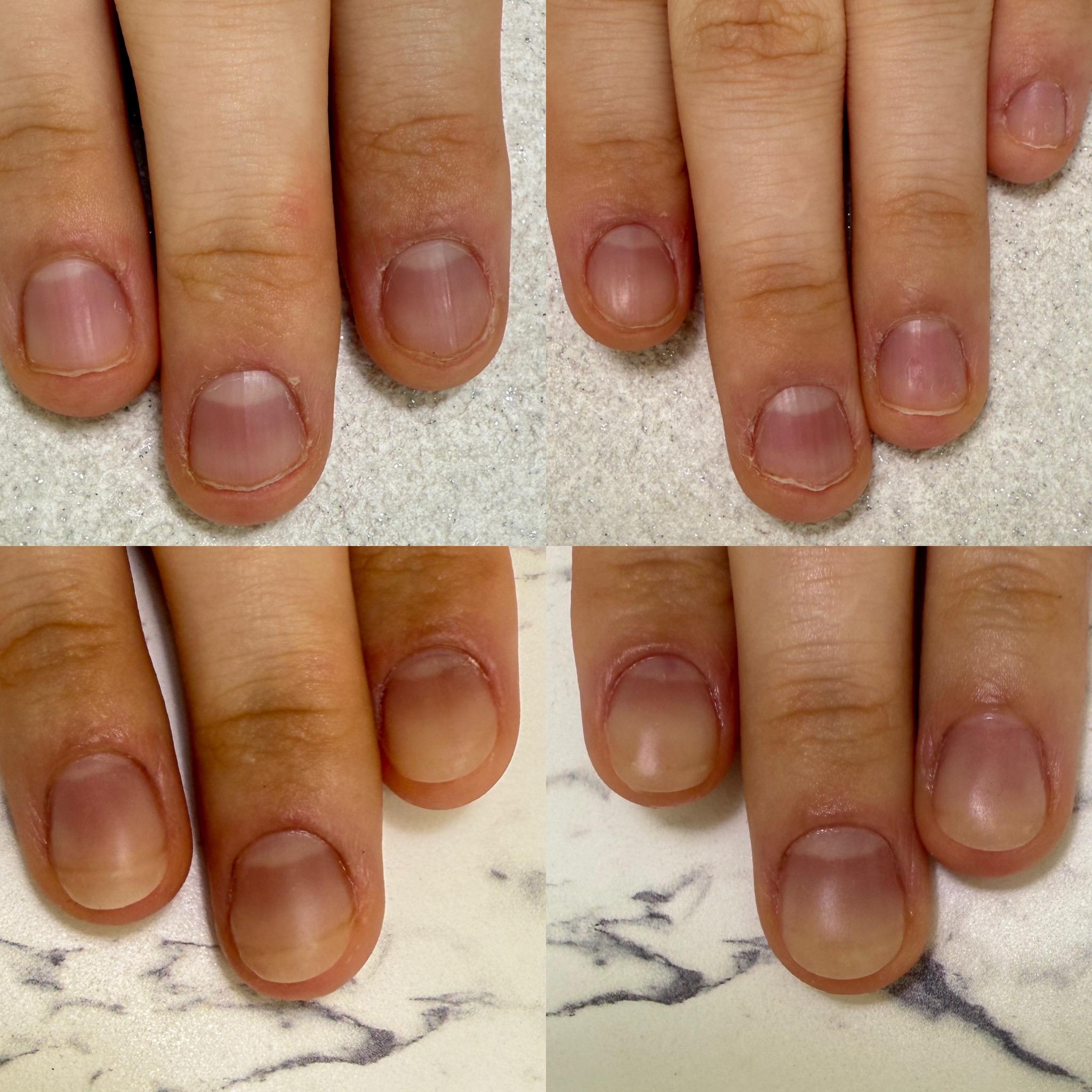 仙台市若林区リプロネイル式深爪矯正専門ネイルサロン デイジー事例写真