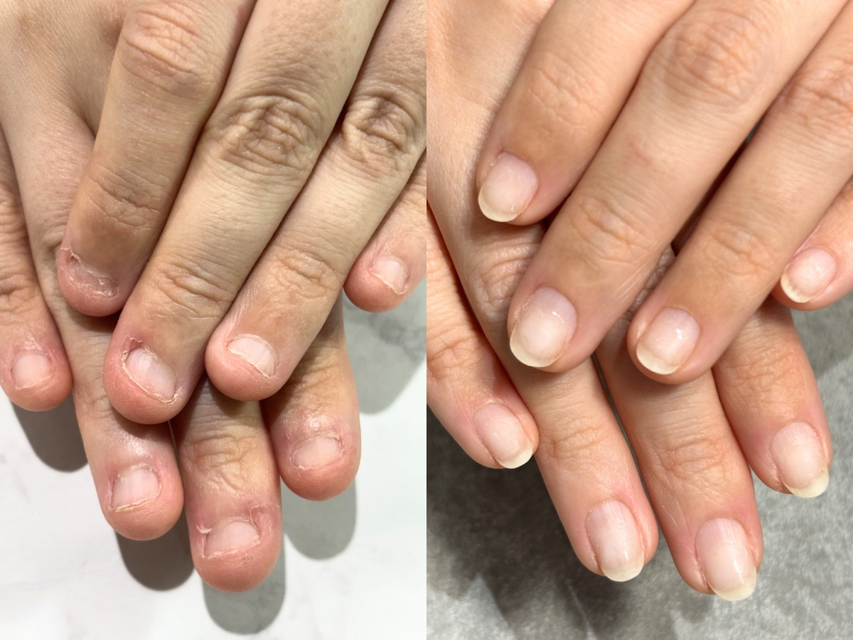 神戸市深爪矯正・爪質改善専門ネイルサロン アリエ リプロネイル式深爪矯正事例写真