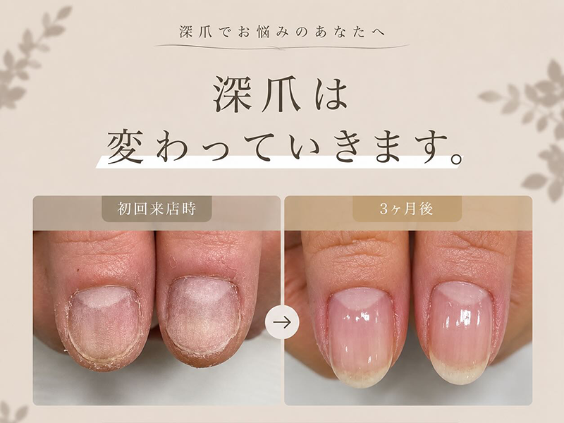 福岡のリプロネイル深爪矯正専門ネイルサロンアニュー