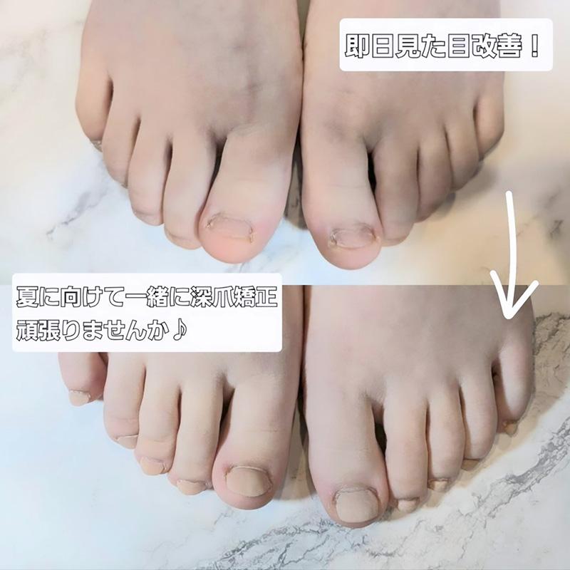 東大阪市リプロネイル式深爪矯正専門ネイルサロン サロン・ド・コロレ事例写真