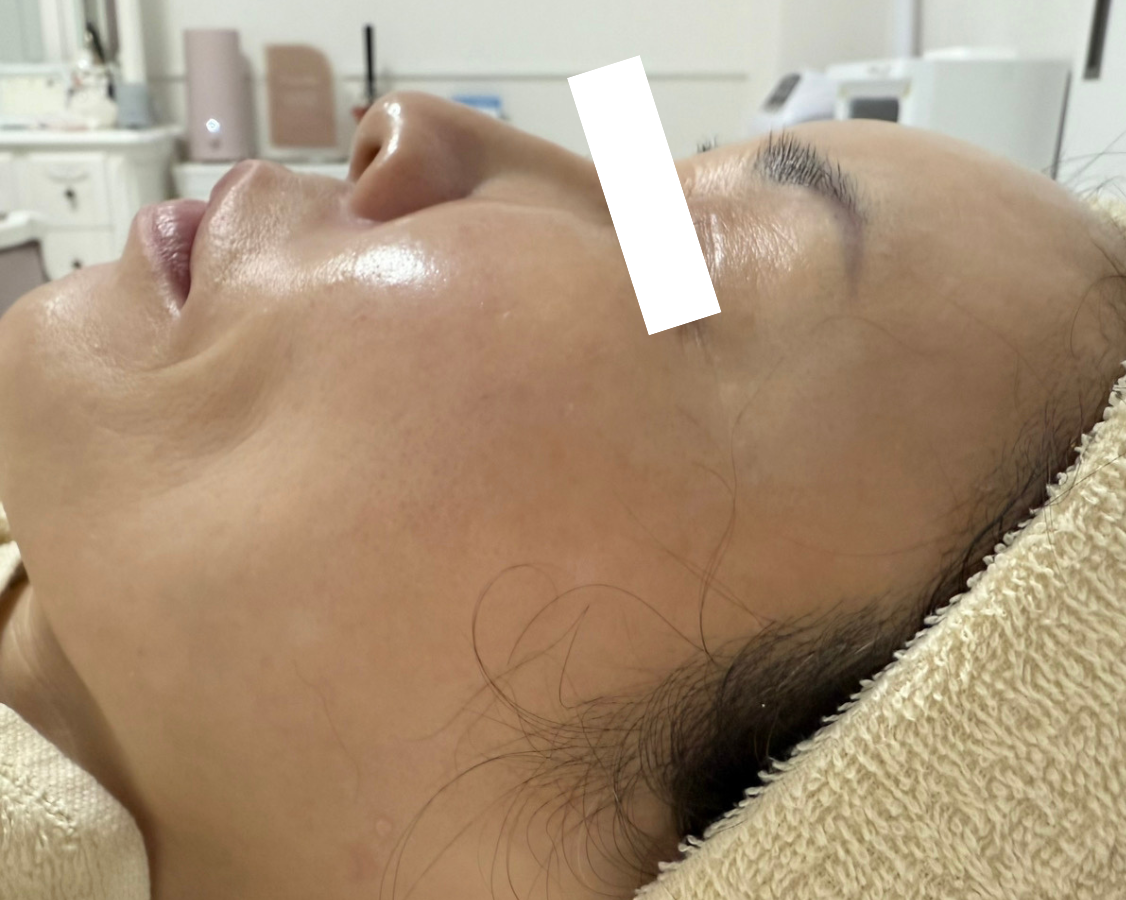 堺市堺区エステサロンVIAGE(ヴィアージュ)フェイシャルのビフォーアフター