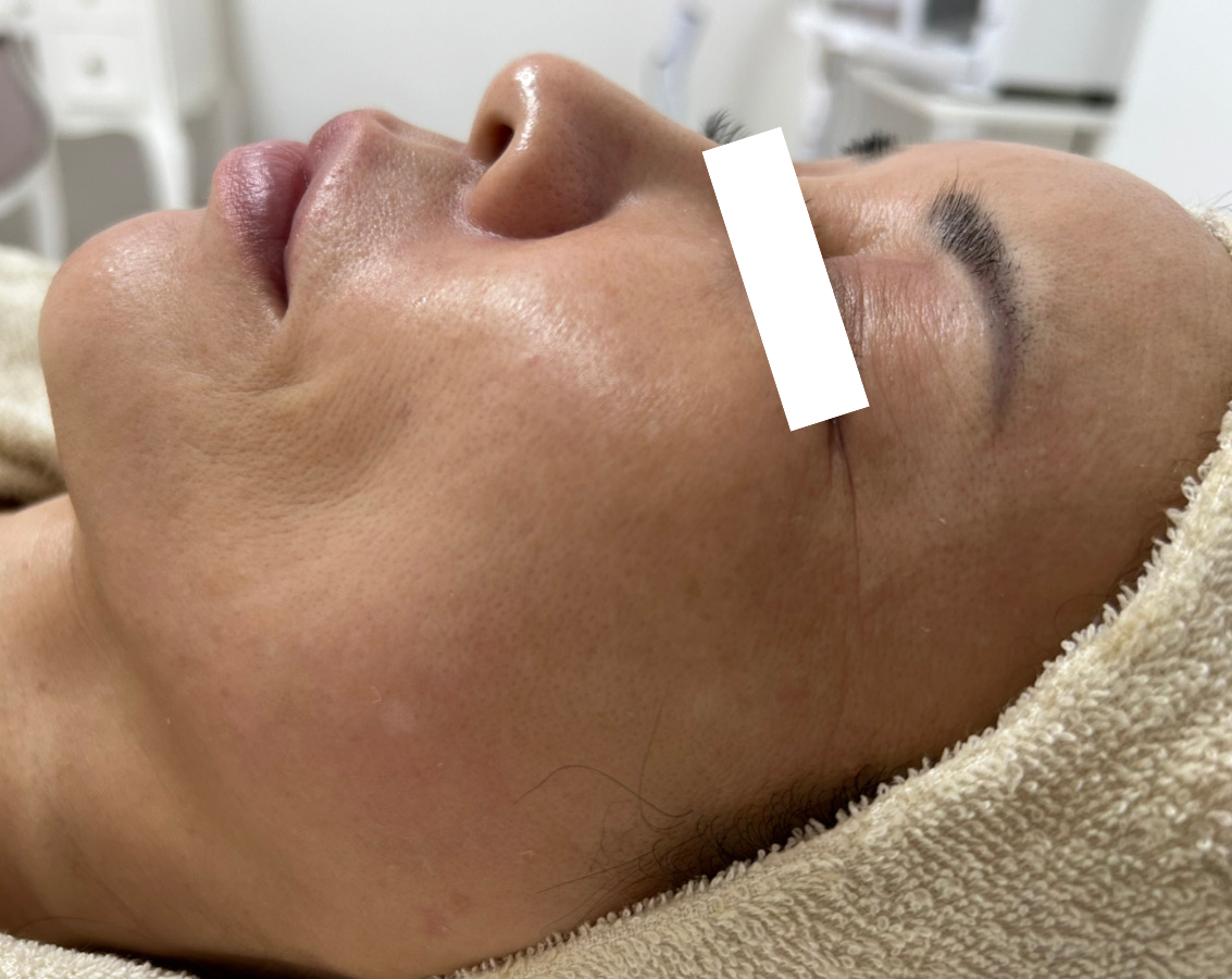 堺市堺区エステサロンVIAGE(ヴィアージュ)フェイシャルのビフォーアフター