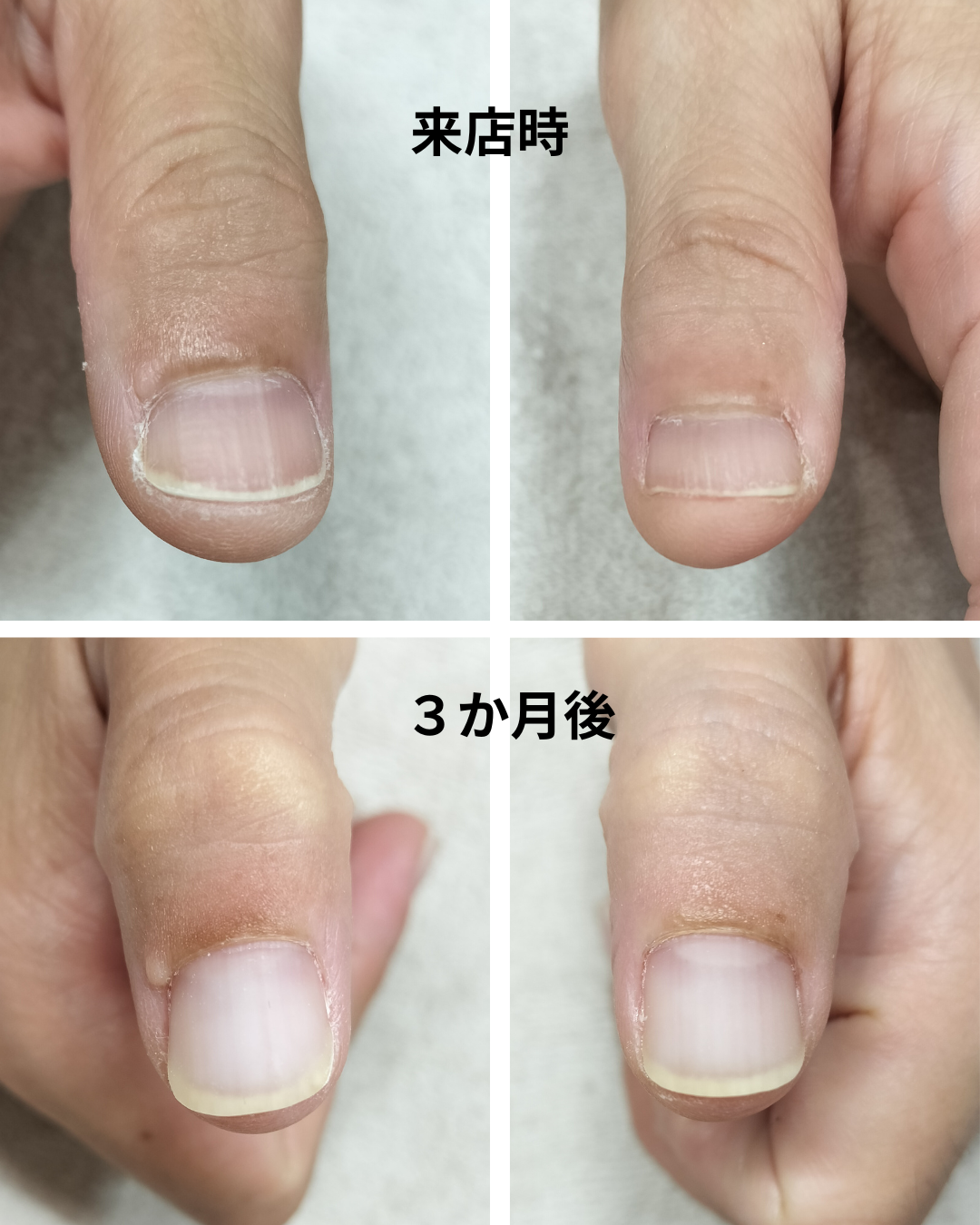 ひたちなか市 リプロネイル式深爪/巻き爪矯正専門店ネイルサロン スピカ事例写真