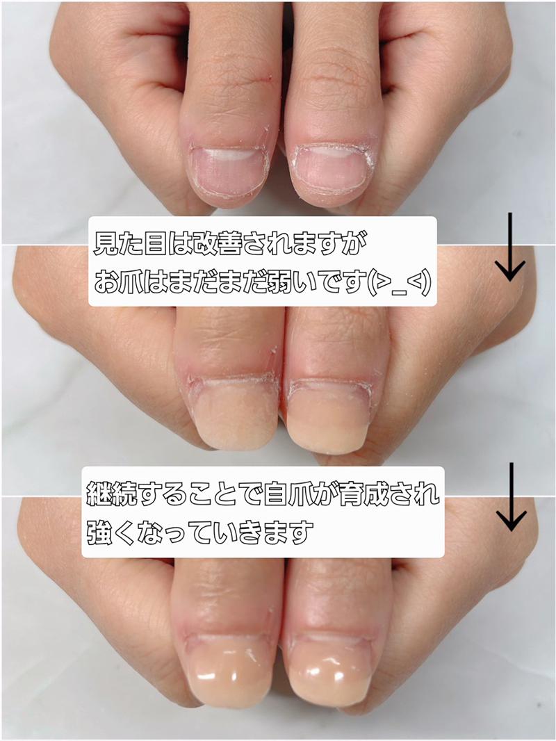 東大阪市リプロネイル式深爪矯正専門ネイルサロン サロン・ド・コロレ