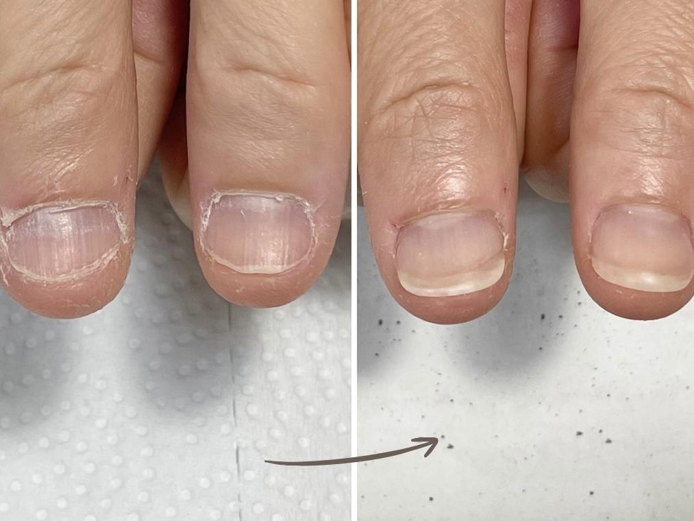 加東市リプロネイル式深爪矯正専門ネイルサロンつきあかり事例写真