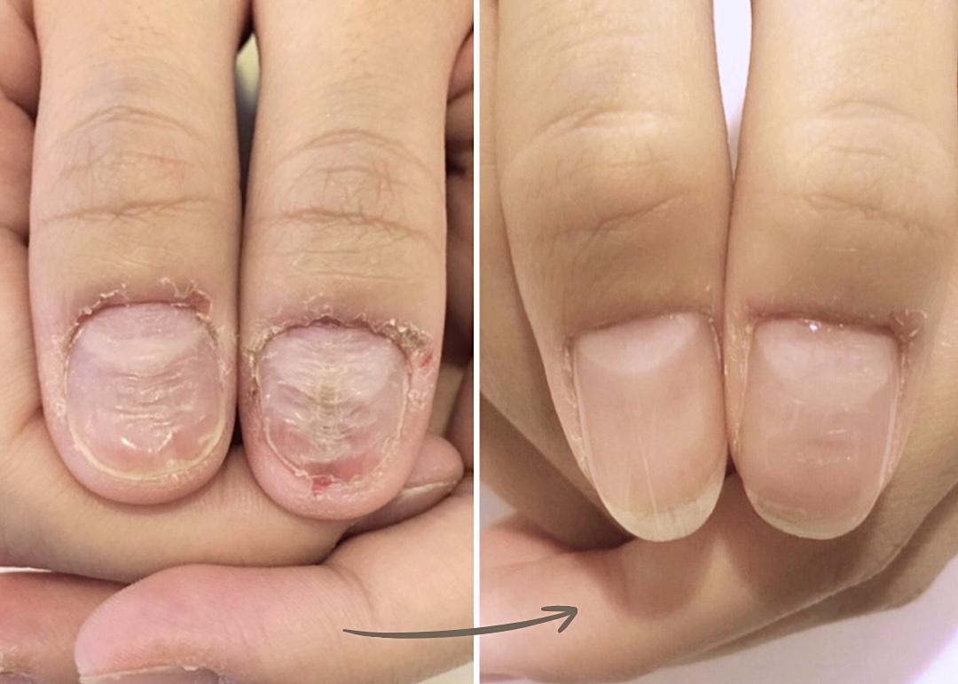 加東市リプロネイル式深爪矯正専門ネイルサロンつきあかり事例写真