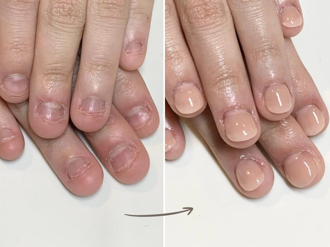 加東市リプロネイル式深爪矯正専門ネイルサロンつきあかり事例写真