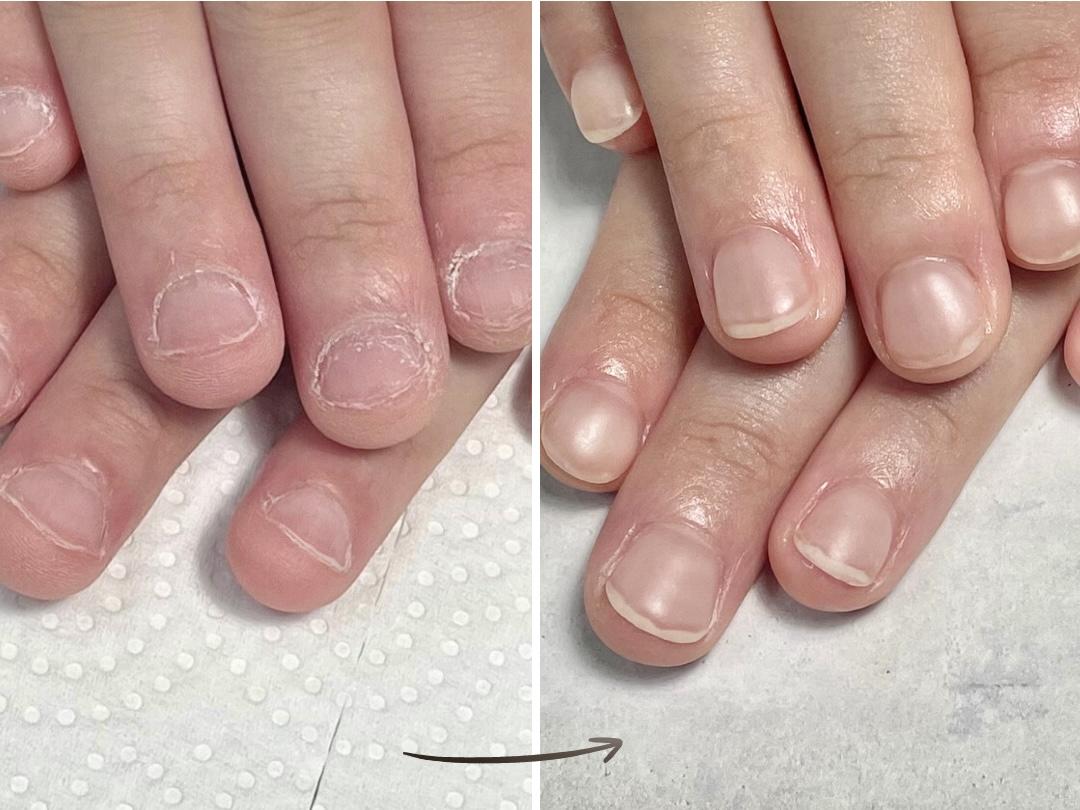 加東市リプロネイル式深爪矯正専門ネイルサロンつきあかり事例写真