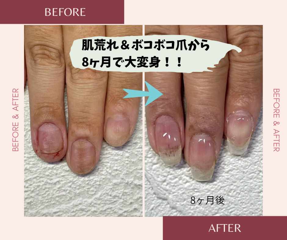 ネイルサロンブルーム リプロネイル式深爪矯正事例写真