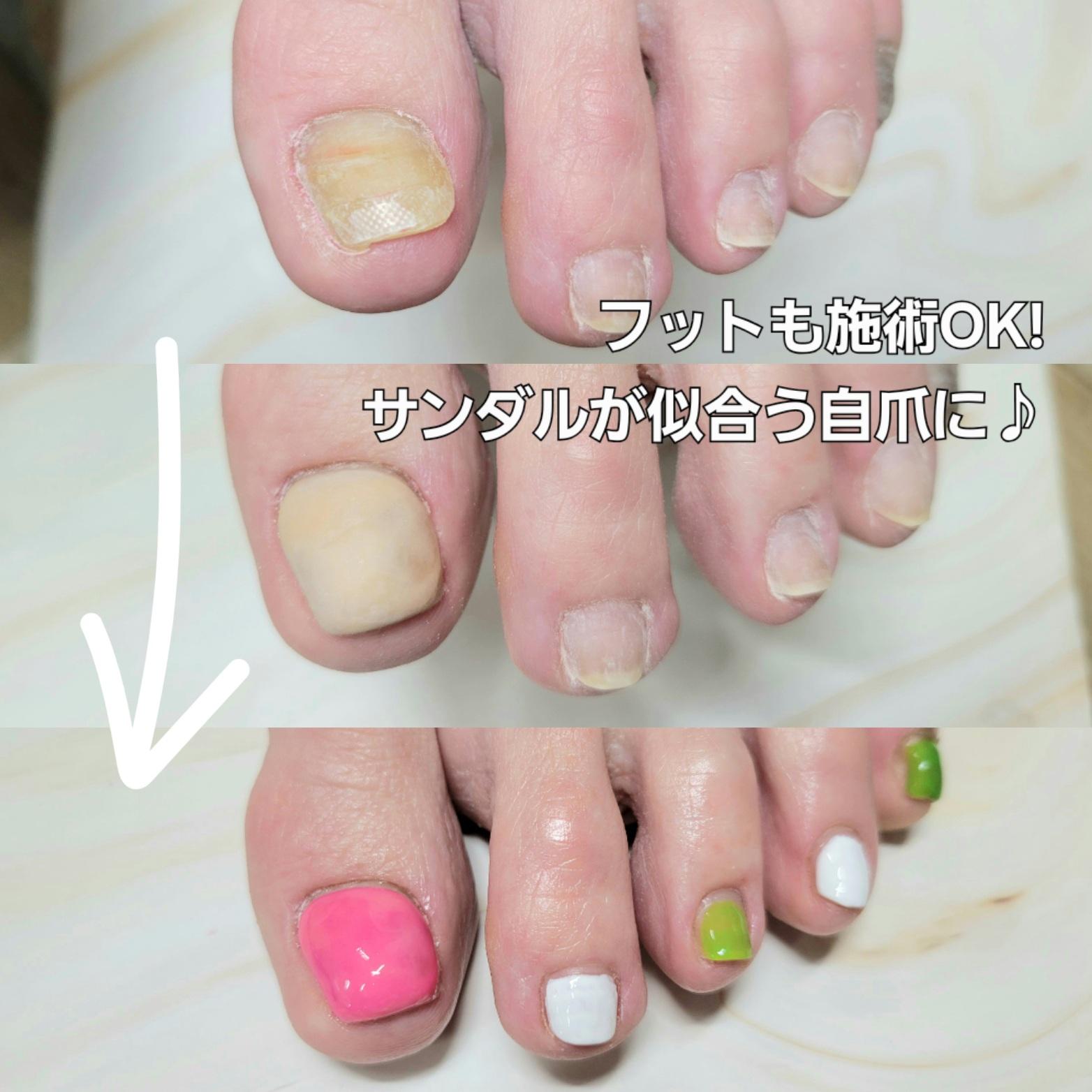 東大阪市リプロネイル式深爪矯正専門ネイルサロン サロン・ド・コロレ事例写真