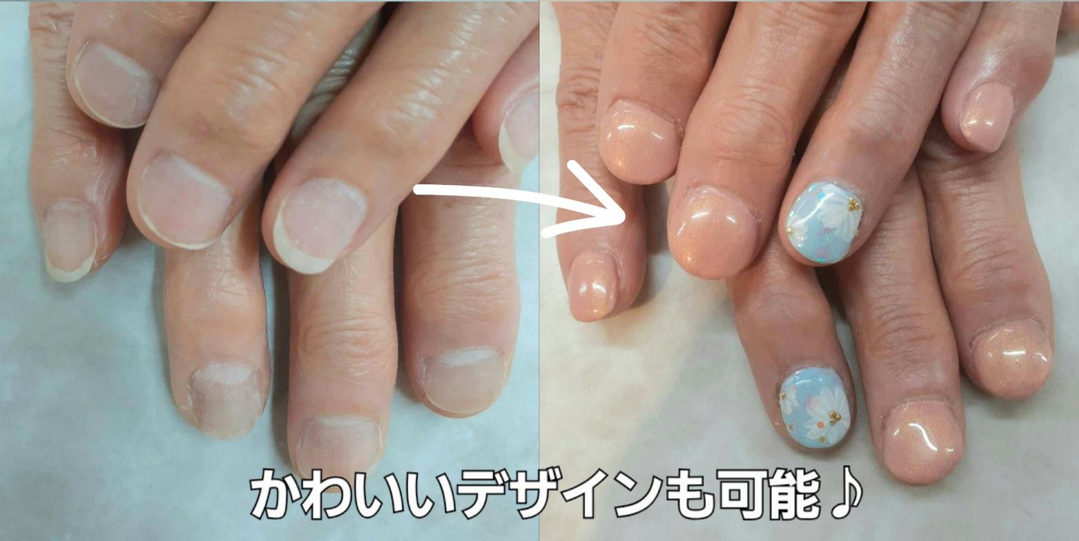 東大阪市リプロネイル式深爪矯正専門ネイルサロン サロン・ド・コロレ事例写真