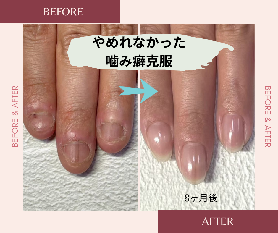 ネイルサロンブルーム リプロネイル式深爪矯正事例写真