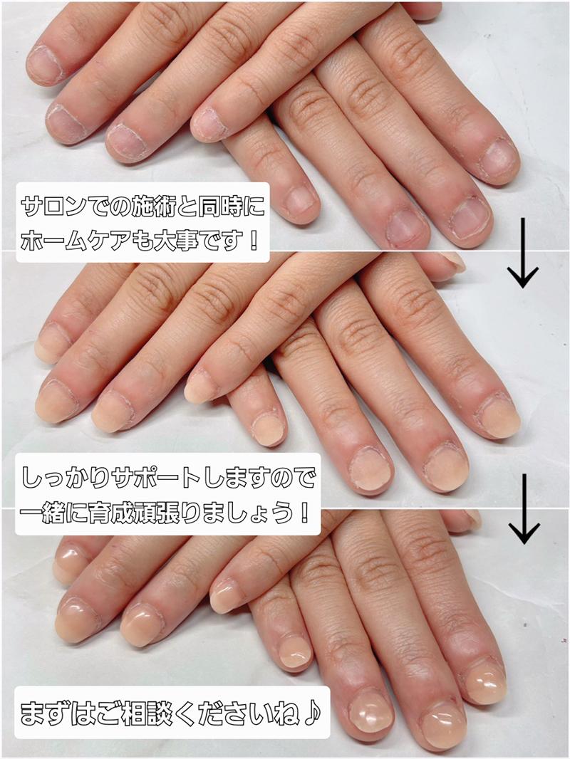 東大阪市リプロネイル式深爪矯正専門ネイルサロン サロン・ド・コロレ