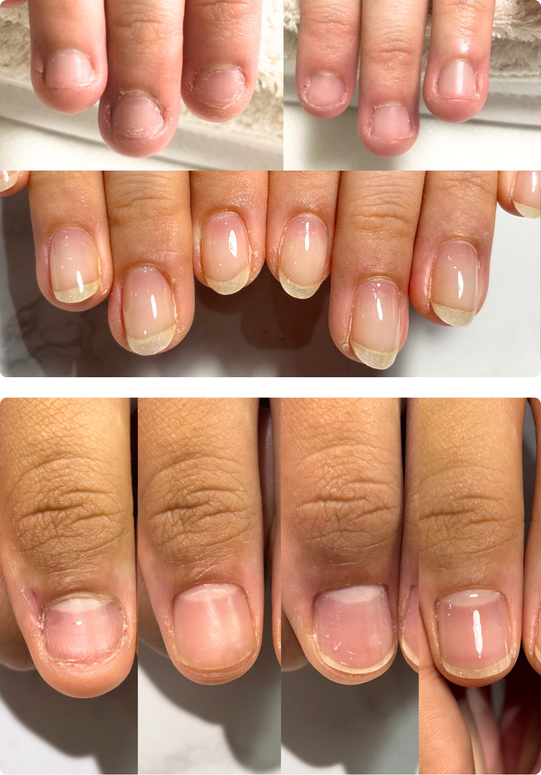 リプロネイル式深爪矯正の事例