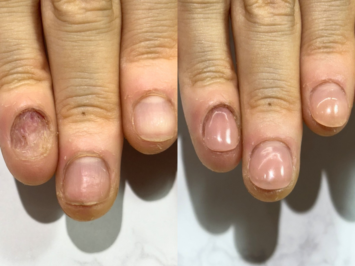 神戸市深爪矯正・爪質改善専門ネイルサロン アリエ リプロネイル式深爪矯正事例写真