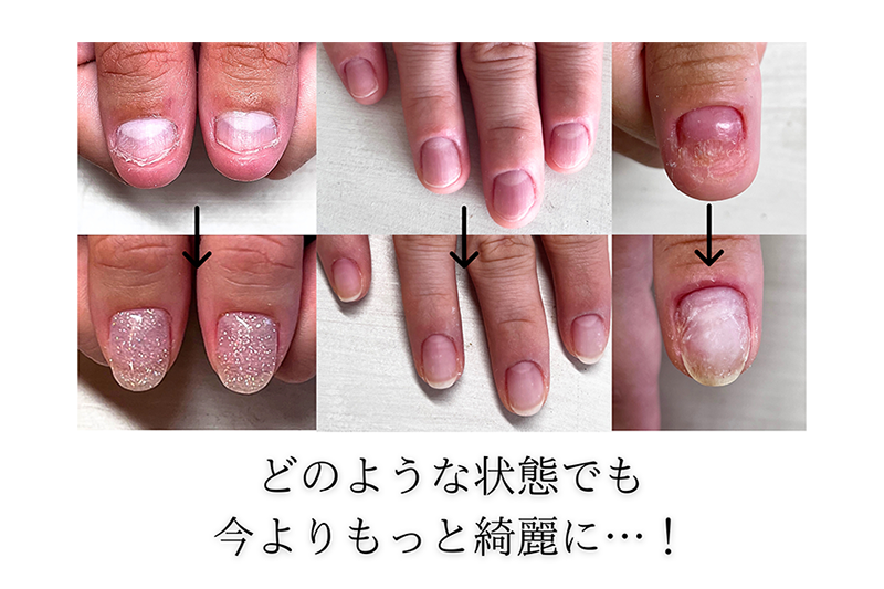 広島市リプロネイル式深爪矯正 ネイルサロンヴェールリム