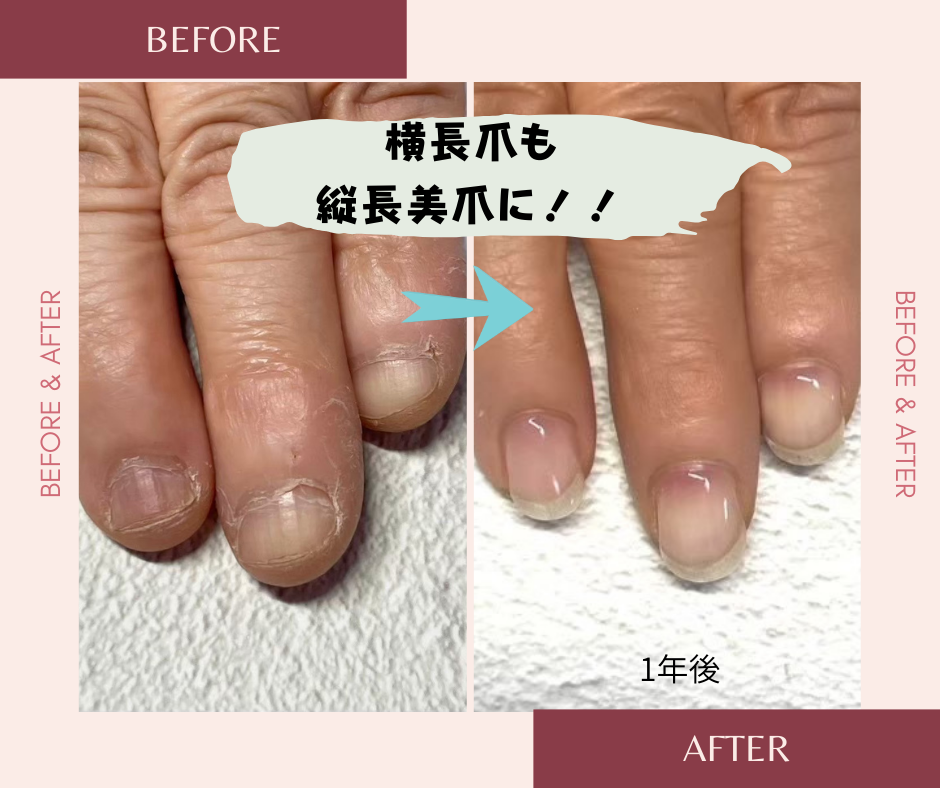 ネイルサロンブルーム リプロネイル式深爪矯正事例写真