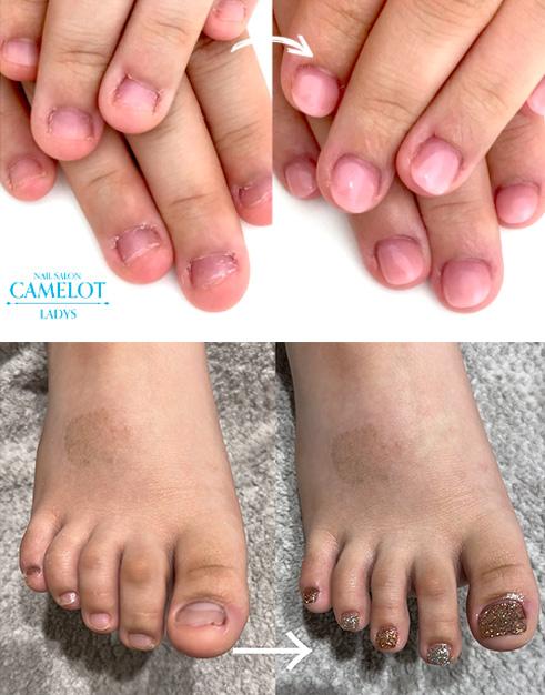 深爪矯正専門ネイルサロン キャメロット横浜店初回深爪矯正メニュー