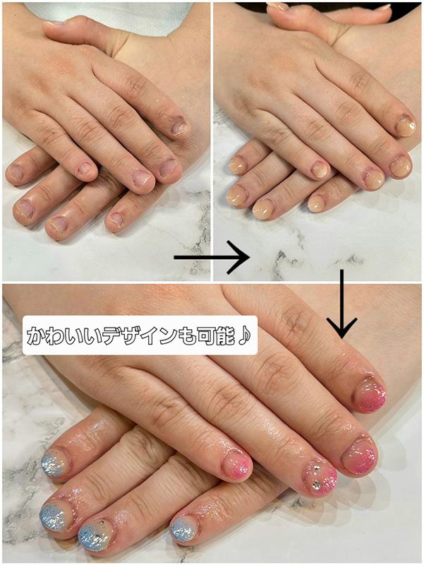 東大阪市リプロネイル式深爪矯正専門ネイルサロン サロン・ド・コロレ事例写真