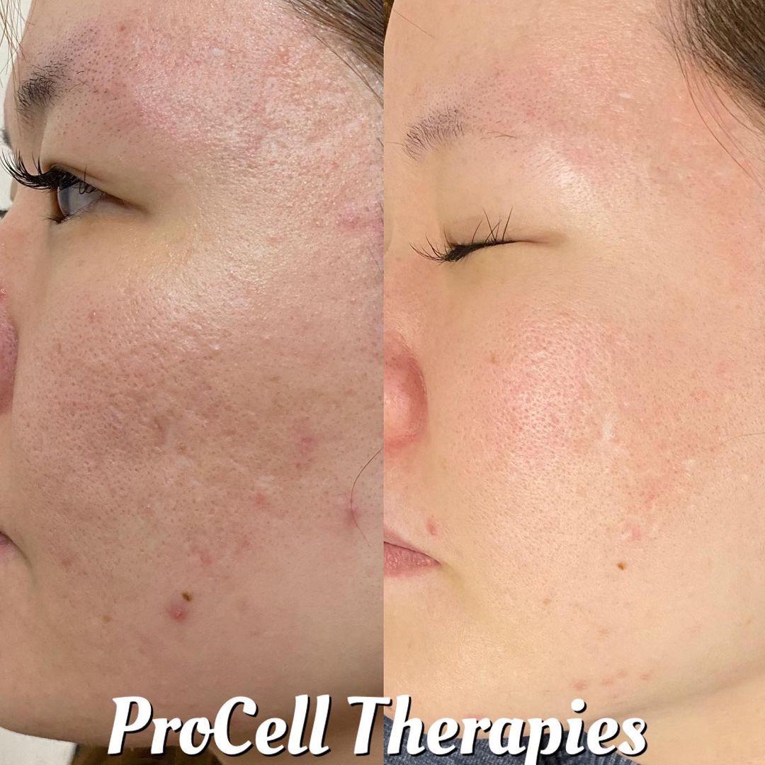 堺市堺区エステサロンVIAGE(ヴィアージュ)プロセルセラピーズ結果写真