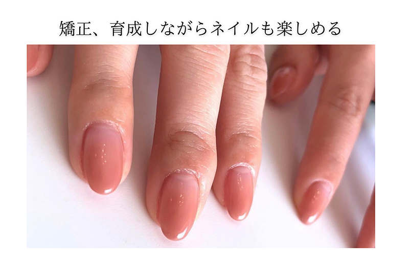 広島市リプロネイル式深爪矯正 ネイルサロンヴェールリム