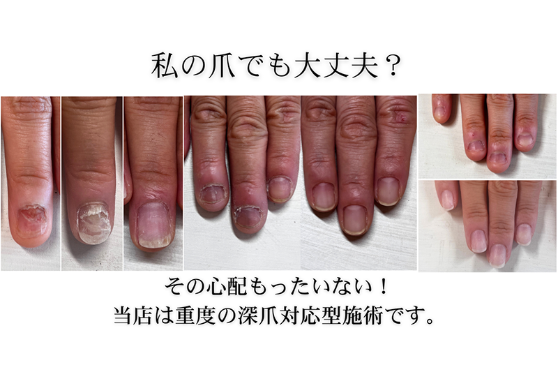 広島市リプロネイル式深爪矯正 ネイルサロンヴェールリム